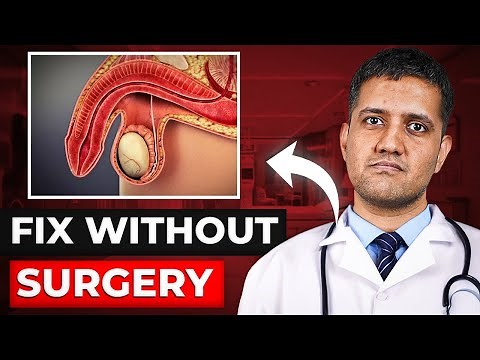 Erectile Dysfunction CURED in 6 Hours | Venous Leak Embolization | Dr. Gaurav Gangwani