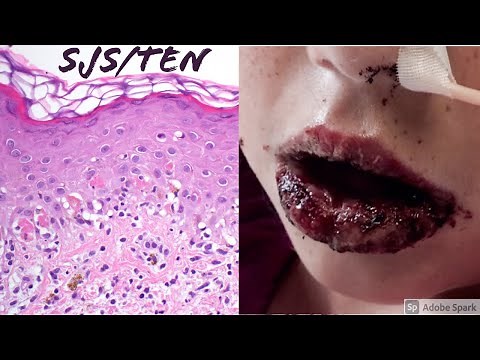 Stevens-Johnson Syndrome/Toxic Epidermal Necrolysis (SJS/TEN) Spectrum