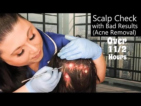 ASMR Scalp Check with Bad Results Compilation (Acne Removal, Pimple Popping) Medical Roleplay