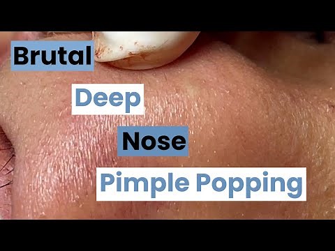 Brutal Deep Nose Pimple Popping — Dermatologist Real Time
