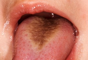 Causes, Treatments, and Pictures of Black & White "Hairy Tongue"