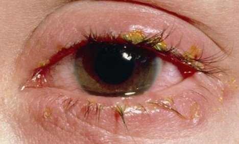 Crusty Eyes, Adults, Newborns, Causes, Symptoms, Treatment