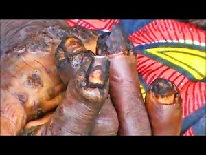 Maria's Jigger Flea Infestation