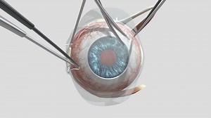 Scleral Buckle - Step 1 - 3D model by Holoxica