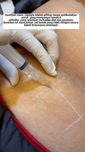❗️PROMO RAYA SLIMMING❗️ ❗️RAWATAN KEMPIS PERUT & CELLULITE . 📌Badan dah normal BMI . 📌Exercise pon dah buat . ⚠️Tapi perut tetap buncit . 💉Rawatan sesuai utk cepatkan fat dissolve & contour perut & love handle. 🎯Result lebih mantap bila combine dgn rawatan Pro Sculpt / exercise / diet💪 . ⚠️Minimal to 0 downtime. | Pesona Clinic & MediSpa