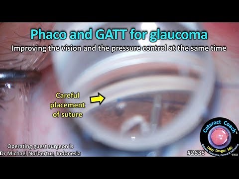 CataractCoach™ 2635: Phaco and GATT for glaucoma