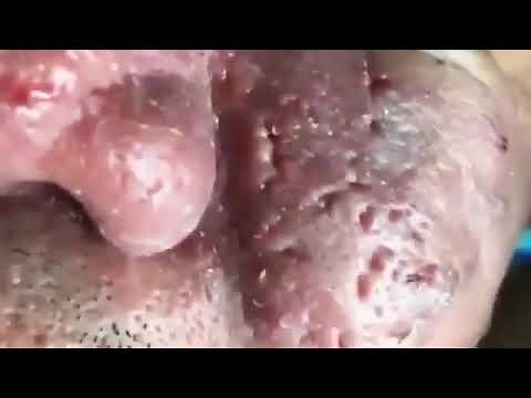Biggest Blackheads on the Nose ever - Pimple Popping Lovers