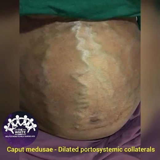 CAPUT MEDUSAE - Dilated Portosystemic collaterals