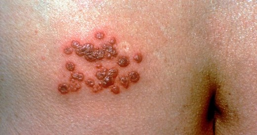 More adult Canadians getting shingles; this is what you need to know