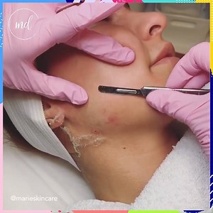 2.2M views · 2.7K reactions | Dermaplane process! So satiisfying to watch  By: @marieskincare | MetDaan Makeup | Facebook
