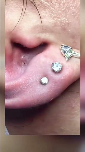 Super squeeze acne asmr #118