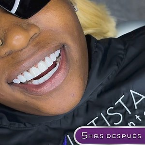 Composite Veneers / Premium Smile 🦷 Get a Amatista Smile 🤩 The highest Quality 👩🏻‍⚕️ The best professionals 💎A luxury service and a total guarantee with more than 25.000 smiles delivered. ✅ 📲FREE ONLINE CONSULTATION BY DM Contact us for your free consultation and change your life. • • #premiumsmile #diseñodesonrisa #cosmeticdentistry #beforeandafter #smiletransformation #dentalveneers #perfectsmile #newsmile #smileporcelain #compositeveneers #sonrisa #carillasdentales #veneers #cambiodeson