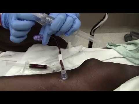 Adult IO Needle Insertion