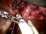 Robotic Right Pneumonectomy • Video • MEDtube.net