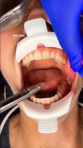 Local anesthesia technique 💉