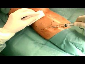 Microflebectomia Ultraselettiva [Dr. G. Serpieri]