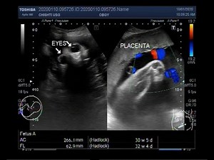 Ultrasound Video showing Anencephaly and Polyhydromnios.