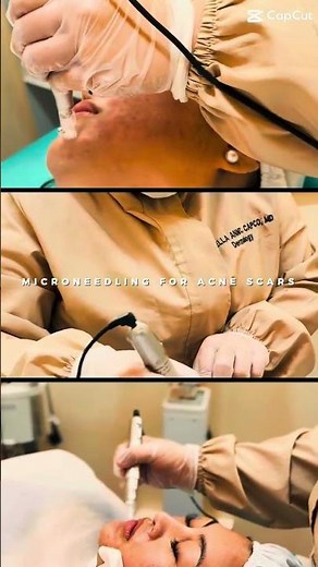 Collagen Induction Therapy