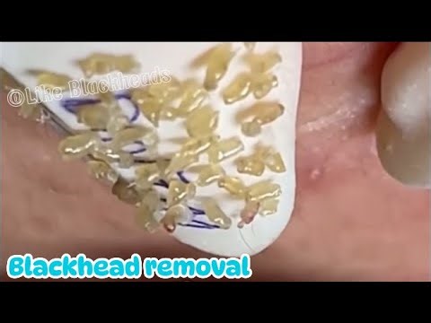HOT: Dr. Blackhead removal, Pimple popping new this week #23