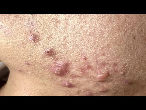 Super Quick Pimples Pop | Làm Sạch Mụn Đầu Đen - SacDepSpa#164