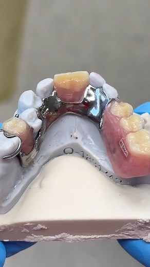 10K views · 18 reactions | Titanium Partial! Case from Dr. Brian Hall in Georgia! | CEO Luke Kahng | Facebook