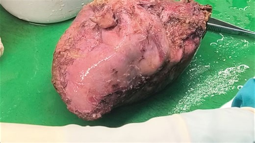 胸腔内这么大的肿物，里面内容物会是什么呢？下个视频揭秘！