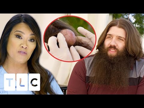 Dr. Lee Removes A QUADRUPLE Cyst On A Man's Head | Dr. Pimple Popper