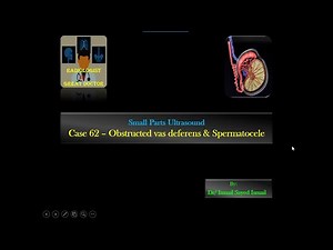 Ultrasound Case 62 - Dilated Vas Deferens and .... (Infertility Scan)