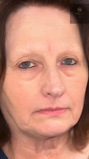 Discover a rejuvenated you at Madam Maha Clinic with our precise microblading techniques. Enhance your natural beauty and achieve a look that makes you feel a decade younger. 💕 #PermanentCosmetics #Microblading #microbladingartist #microbladingeyebrows #beautyforeverwithmaha #madammahaclinic #permanentmakeup, #browsonfleek, #eyebrowsonpoint, #lipblush, and #cosmetictattoo #beauty #advertising #hashtags #microbladingandpermanentmakeup #cosmetictattooing #brows #lips #eyebrows #makeup #beautyindu