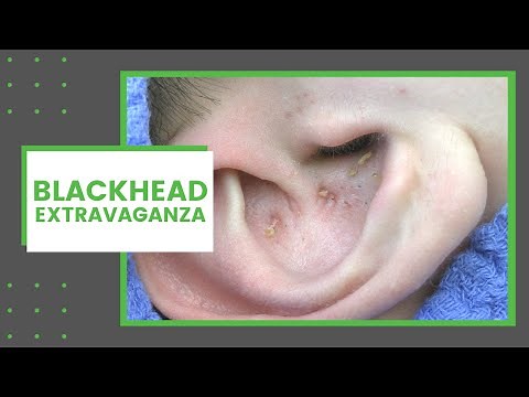Blackhead Extravaganza | Dr. Derm