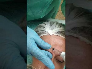 Como rellenar frente,entrecejo con Acido Hialuronico? Sin aguja con Hyaluron pen?