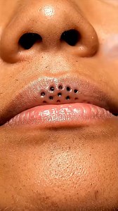 2.4K views | Ultimate Blackhead Popping Compilation – Relaxing ASMR | Dr. Mandy | Facebook