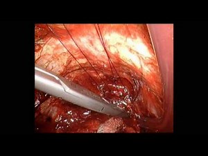 Radical Prostatectomy - Functional Urethral Sphincter Preservation • Video • MEDtube.net