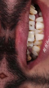 Going for Natural: Full mouth rehabilitation to restore healthy gingiva (remove infections), as well as alter tooth alignment, shape, and color, making the mouth appear more uniform and natural-looking as it should.التوجه نحو العلاج الطبيعي: إعادة تأهيل كامل للفم لاستعادة اللثة الصحية (إزالة الالتهابات)، بالإضافة إلى تغيير محاذاة الأسنان وشكلها ولونها، مما يجعل الفم يبدو أكثر تجانسًا وطبيعيًا كما ينبغي✨....#veneers #dentist #hollywood_smile #teeth #زيركون #قشور_تجميلية #Jordan #Amman | Dr Ali Om