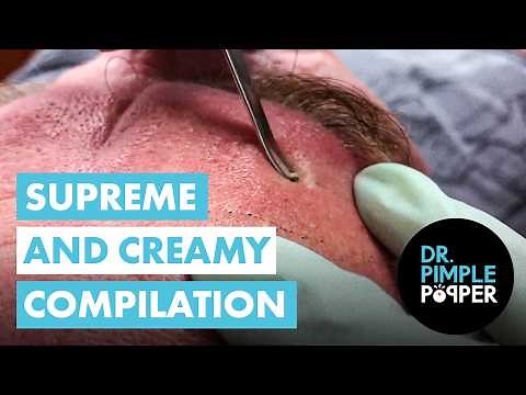 Supreme and Creamy Blackhead Pops & Veteran’s Story... Most Satisfying Pimple Pops Compilation
