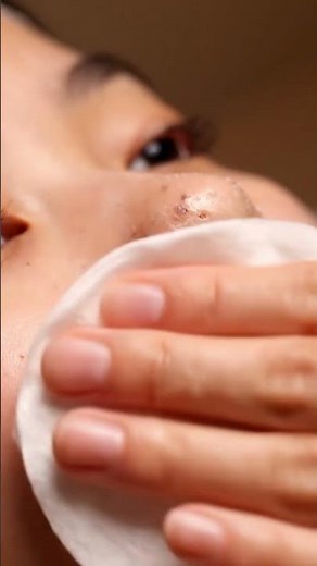 Realistic ASMR Blackhead & Whitehead Removal | Deep Skin Cleansing with Suction Tool | Spa.