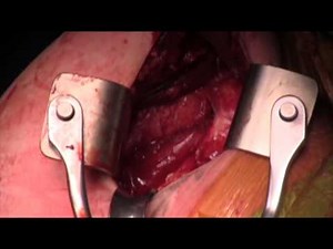 Closed Reduction and Subscapularis Transfer for Locked Posterior Shoulder Dislocation