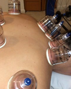 Cupping . How do you use cupping in your practice? . 🔺By twisting the cups we are encouraging the fascial tissues to lengthen and deform it’s shape in a whole manner of directions not just a straight lines . 🔺This form of cupping is primarily used to treat fascia, the connective webbing surrounding all tissues and muscles. Dynamic Cupping therapists follow the lines of fascia running throughout the body in order to realign and restructure the tissue . Benefits of Dynamic Cupping: 🔺Restructure