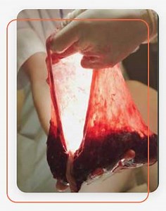 Umbilical Cord Stem Cell Therapy