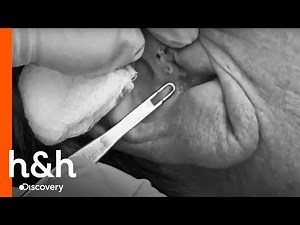 Dra Sandra Lee realiza gran extracción de milia de los oídos | Dra. Sandra Lee | Discovery H&H