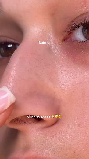 Softening your sebum is 1010☺️✨ @ilso_global natural mild clear nose patch 👃 . This melts the excess sebum within your pores & then I extract them easily using a tool. Purchased mine from #lifestyle #2025readingchallenge #stanleycup #asmrcooking #dance #food | Hannah St Luce