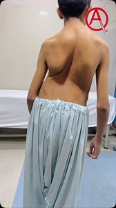 Common syndromes associated with syndromic scoliosis include Marfan syndrome, Ehlers-Danlos syndrome, Loeys-Dietz syndrome, Down syndrome, Rett syndrome, Achondroplasia, neurofibromatosis, and Prader-Willi. Professor Naveed Khan Neuro-Spinal Surgeon Specialist in treatment of back-related issues from back pain to scoliosis. Special interest in brain surgery including brain injuries & brain tumour (cancer) surgery. OPD every Monday, Tuesday, Thursday & Saturday For Appointments call : Mr Hassan 0