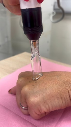 Instant wrinkle removal honestly what a machine #hotcoldplasma #aesthetics #pigmentation #injectables #learning #aesthetics #plasma #plasmatechnology #skincare #plasma #skin #SkincareGoals | Rebecca Aesthetics Barton