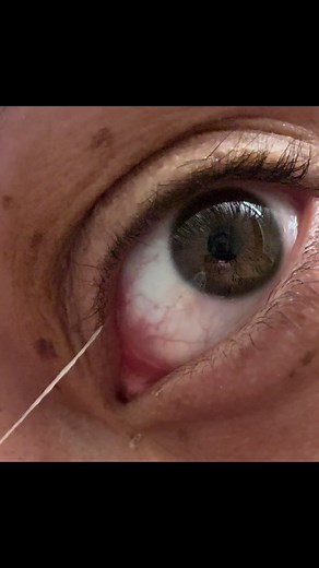 Bad Habits: Understanding Eye Mucous