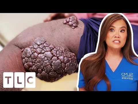 Dr. Lee Is STUMPED By Large Clustered Leg Lumps | Dr. Pimple Popper