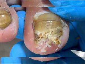 The inside of the toenail appears to be rotten, remove it.
