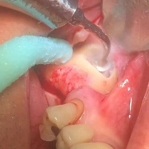 By @surgical_gourmet ・・・ Open sinus lift entry using piezo. While it necessary, I prefer using a piezo for sinus membrane protection. . . . . . . . #loveyouroralsurgeon #hugyouroralsurgeon #ButYouOnlyLikeBloodyPics #omfs #oralsurgery #prp #implantdentistry #implant #implants #dentist #dentistry #oc #dentalhygiene #allon4 #prosthodontist #nobelbiocare #nobelbiocareimplants #about_dentistry #prosthodontics #missionviejo #lagunaniguel #irvine #cirugía #cirugia #cirugiabucal #implantesdentales #impl