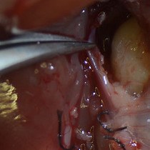 Video: Mouse Model for Pancreas Transplantation Using a Modified Cuff Technique