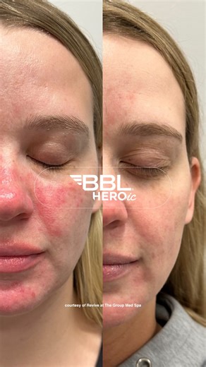 7K views · 11 comments | Breakouts? Redness? Inflammation? BBL HEROic...