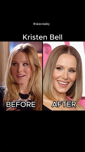 ✨ Spotted: Not a glow-up. A game plan. ✨ Blake Lively didn’t build that red carpet face overnight — and neither do we. This is structure with strategy — where artistry meets medical precision to enhance balance, proportion, and timeless beauty. 📌 Book a complimentary consultation and personal assessment today to discover your personalized full-face treatment plan. ___ full face rejuvenation, facial balancing, facial contouring, full face filler, beauty planning, blake lively aesthetic, celebrit